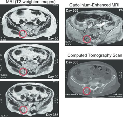 MRI and computed tomography scan of iliac BM. MRI T2- weighted images ...