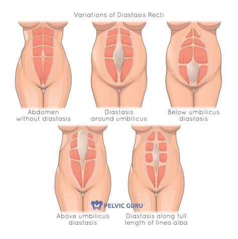 workout for women with Diastasis Recti Abdominis or â€œseparated absâ ...