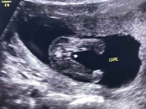 15/16 week ultrasound boy or girl?! | BabyCenter