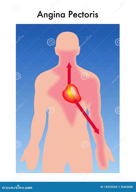 Angina Pectoris Banner, Line Icons. Symptoms. Vector Signs For Web Graphics. | CartoonDealer.com ...