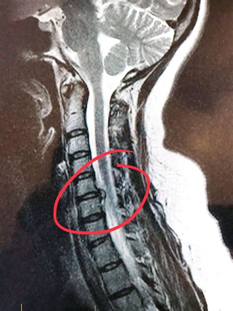 I was told I had Cervical Spinal Stenosis, but it looks more like a ...