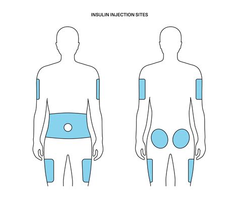 Insulin Injection Sites: Where and How to Inject?