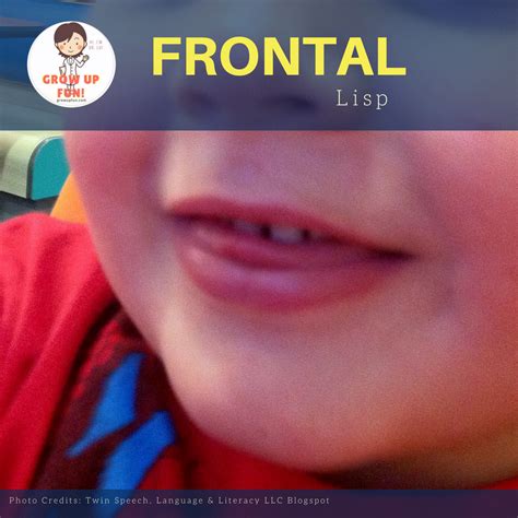 Dental Approach to Correcting Lisp in Children – Grow Up Fun