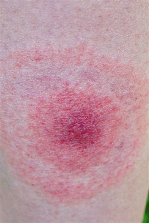 Lyme disease rash: Symptoms, stages, and identification