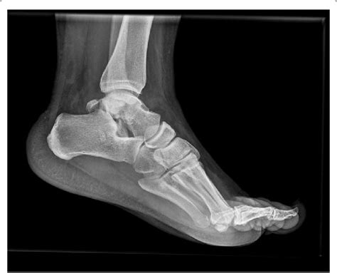 Foot and Ankle true lateral view. Sustentaculum tali fracture and... | Download Scientific Diagram