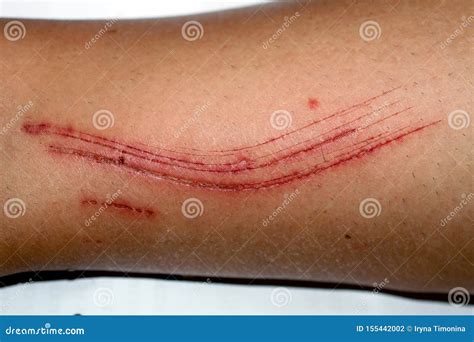 940 Skin Abrasion Stock Photos - Free & Royalty-Free Stock Photos from ...