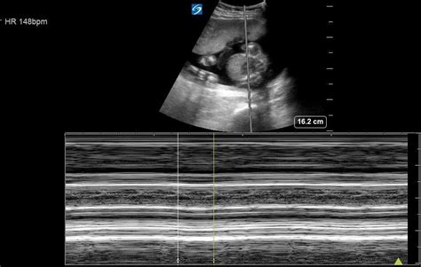 M-Mode (Yes) vs Doppler (No) | ALARA | Fetal Heart Rate — Everyday Ultrasound