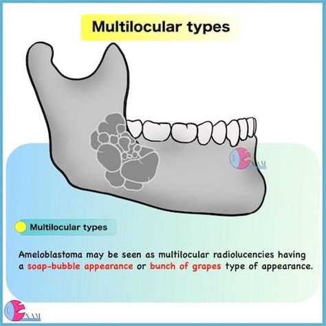 Ameloblastoma Radiology: Dental Radiology Notes