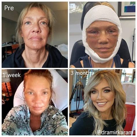 Cosmetic Insider on Instagram: “Repost from @cosmetic.derm • Recovery ...