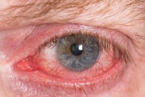 Welding Flash - Arc Eye 11 Home Remedies That Work Fast