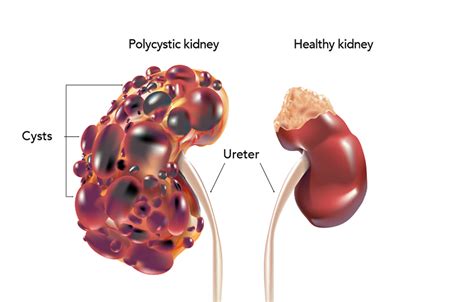 Polycystic Kidney Disease (PKD)