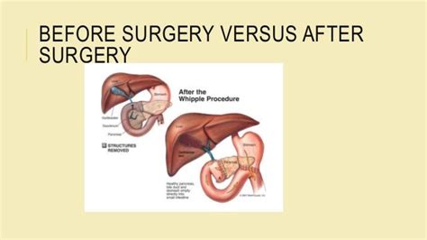 Nutrition After Whipple Procedure - Nutrition Ftempo