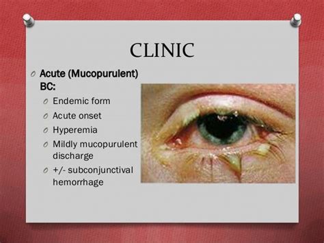 Bacterial conjunctivitis