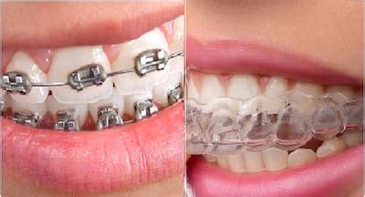 The Pros and Cons of Orthodontic Clear Aligners | TheHealthSite.com