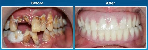 Ugly Teeth Before And After