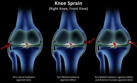 Knee Buckling: What Can Cause Knees To Buckle?