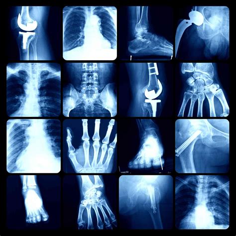 Osteopetrosis: Symptoms, Treatment, and More