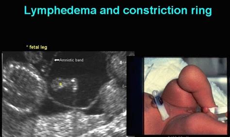 Amniotic Band Syndrome (ABS)