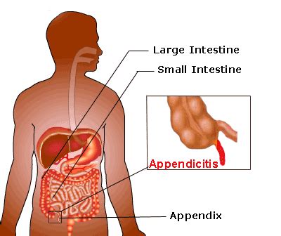 Appendix Pain - Location, Symptoms, Causes, Treatment, Diagnosis ...