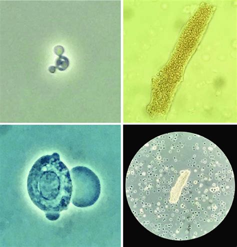 Acanthocytes and red blood cell casts (Reproduced with permission ...