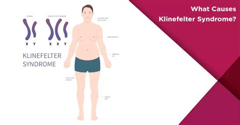 Klinefelter Syndrome: All You Need To Know – Sdlgbtn, 56% OFF