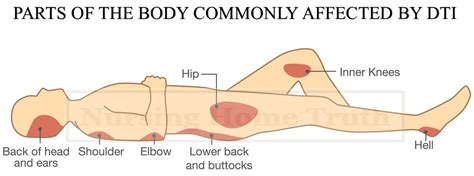 Deep Tissue Injury Treatment **(2023 Updated Research)**