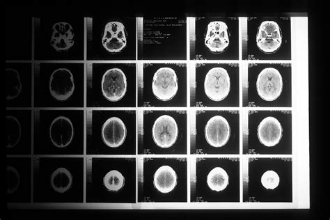 Tumor: Brain Tumor Diagnosis