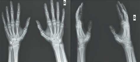 Plain radiographs where transverse fracture of the capitate not seen ...