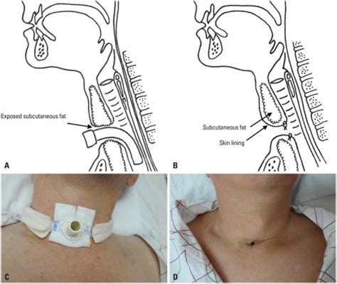 A schematic comparison of conventional tracheostomy and | Open-i