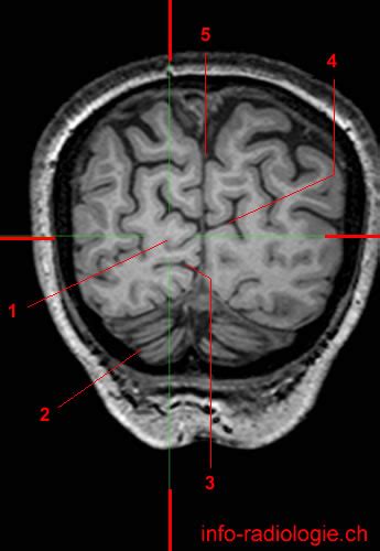 Occipital lobe (MRI)