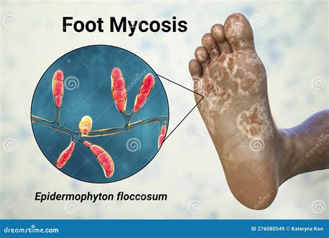 The Foot with Mycosis, and Close-up View of Fungi that Cause Athlete S Foot, 3d Illustration ...