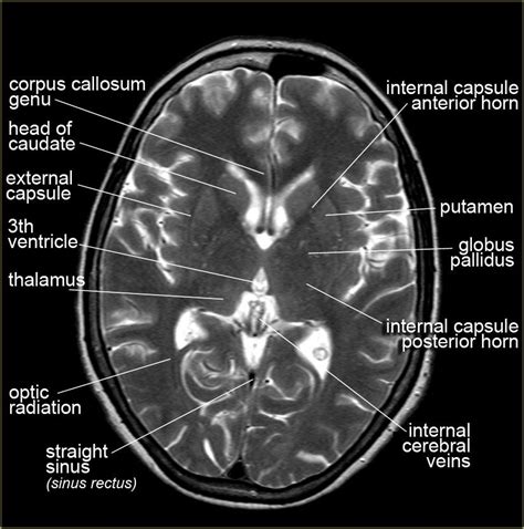 . Radiology Student, Radiology Imaging, Medical Imaging, Basal Ganglia ...