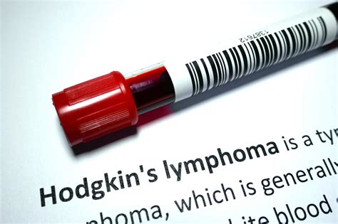 92% Survival Rate: Immunotherapy Boosts Survival of Advanced Hodgkin Lymphoma