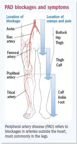 Peripheral arterial disease Guide: Causes, Symptoms and Treatment Options