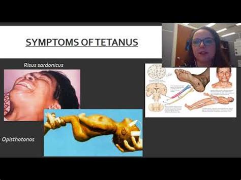 Clostridium Tetani Symptoms