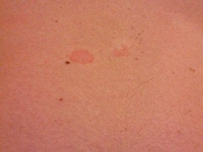 I Have Red Spots Developing on my Chest and Stomach Area. More and More Have Been Showing Up and ...