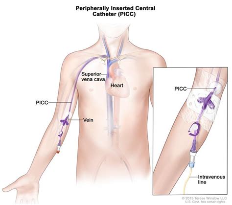 PICC Line Placement CPT Code - Knowledge Center