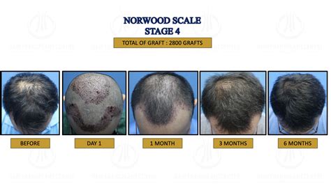 Norwood Stage 4| Hair Transplant Centre | Malaysia Hair Treatment