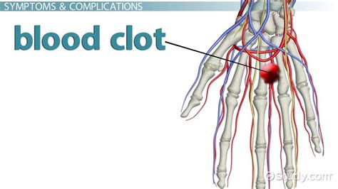 Blood Clot In Forearm