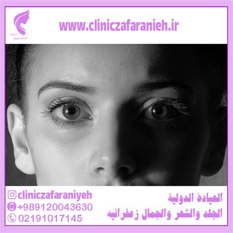 Complications of Upper Eyelid Surgery - کلینیک بین المللی پوست و مو زعفرانیه