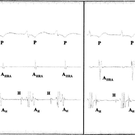 Left: 12 lead ECG of AVNRT with visible retrograde P wave in a woman of... | Download Scientific ...