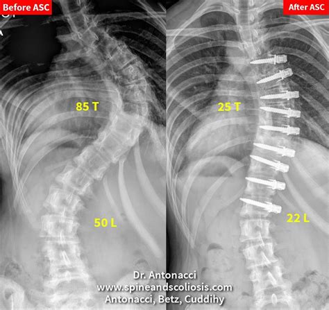 SA 14 Scoliosis Single Severe Curve from 85 Thoracic - Institute for Spine and Scoliosis