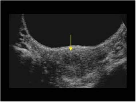 Gynaecology | 3.1 Uterus : Case 3.1.1 Uterine fibroids | Ultrasound Cases