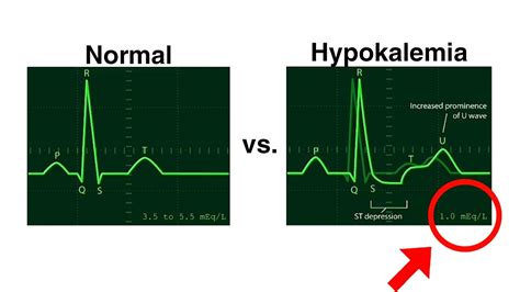 Hypokalemia Ecg Normal Vs Hypokalemia Ecg Changes In Hypokalemia | The Best Porn Website