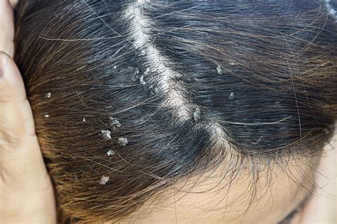 Dandruff and Seborrheic Dermatitis | Treasure Valley Dermatology | Dr. Dustin Portela