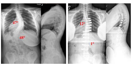 Degree Scoliosis Cervical Curve