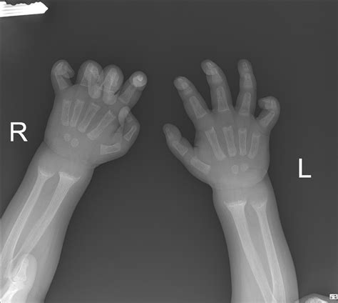 Rickets Disease X Rays