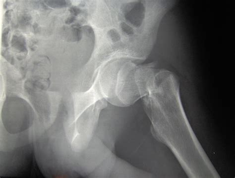 Hip Fractures in Older Adults: An Important Source of Morbidity