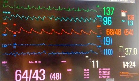 Pedi cardiology: ICU: Monitor - s/p ASO, Doing well