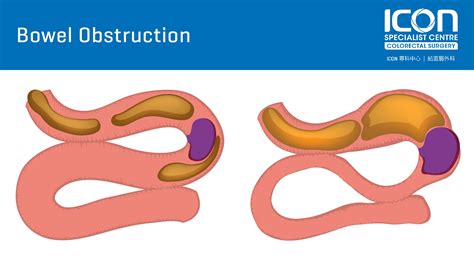 Bowel obstruction — Icon Specialist Centre